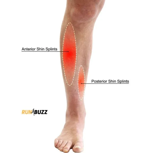 Shin splints anatomy showing the tibia and surrounding muscles